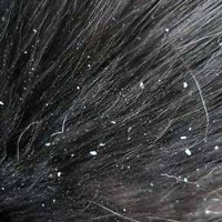 dandruff relief - holistic remedy