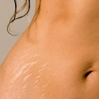 Vanishing Act Organic Stretch Mark & Scar Diminishing Serum - Lighten and diminish stretch marks and C-section scars safely and naturally. Our deeply nourishing base of pomegranate and rosehip seed oils provides essential reparative skin nutrients and healing anti-oxidants while essential oils of organic lemon and carrot seed even out skin tones, promote skin regeneration and help diminish stretch marks and scars.